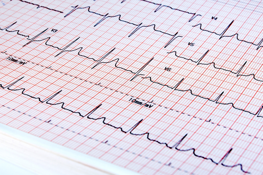 ECG